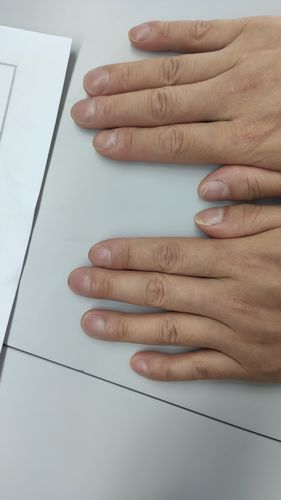 网上查了好多,觉得有点近似,但指头前部没有明显肿胀变大的感觉.