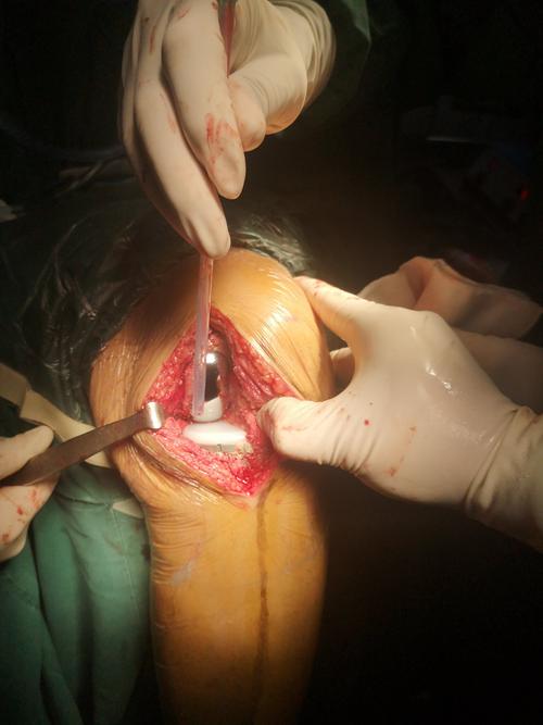 手术技术日臻完善 ,但对于一些单间室病变的患者全膝关节置换手术有些