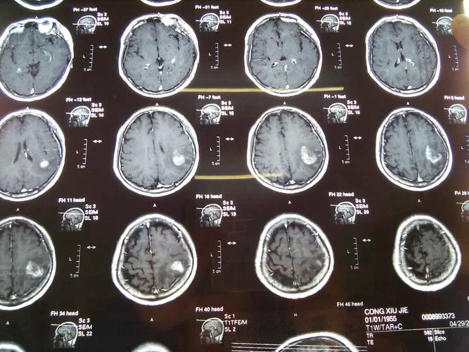 求救!我大娘脑子里长了个脑瘤,医生说是恶性瘤!