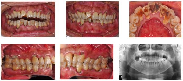 慢性牙周炎伴牙槽骨吸收 口腔护理习惯改善牙周状况