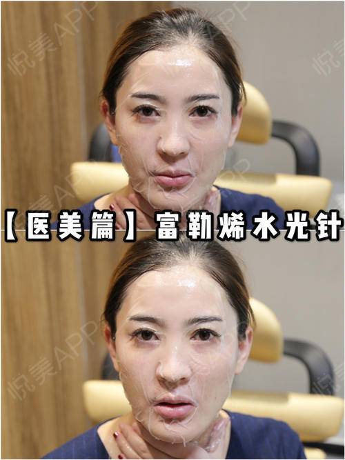 医美篇富勒烯水光针