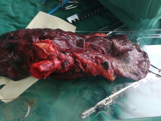 医院 外四科近日完成一例心包内结扎左上肺静脉行左全肺切除…(副本)