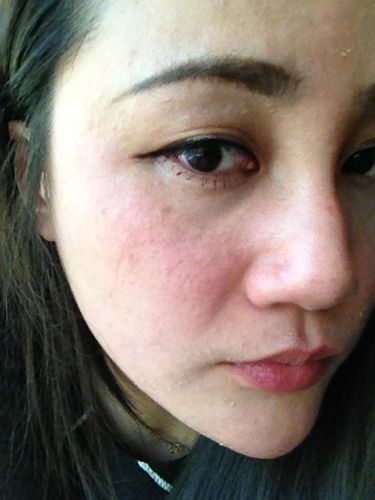 皮肤性病科 皮肤科 皮肤过敏 → 脸上脸颊发红,起疙瘩,脱皮,是过敏吗?