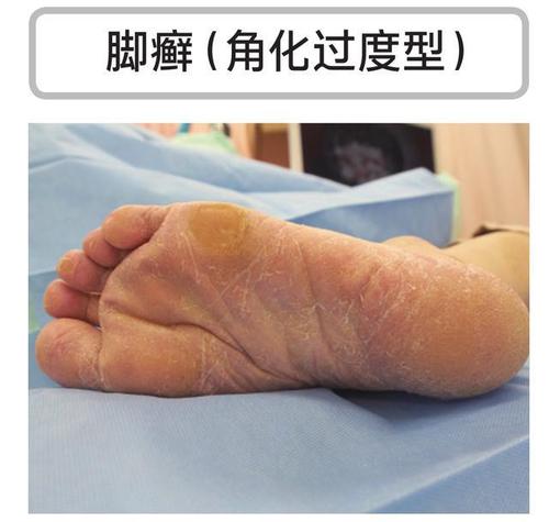 角化过度型脚气