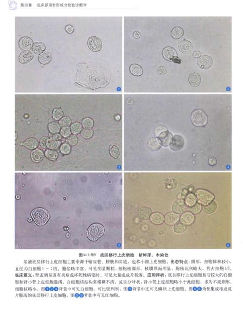 其它 18检验二班杜蓉蓉 尿液中的细胞及其他 写美篇 底层移行上皮细胞