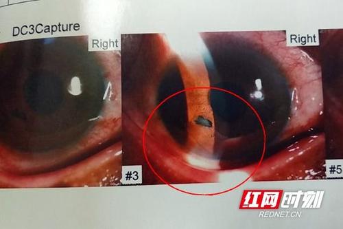 视频丨惊!铁屑飞进眼球"躲猫猫",常德医生巧手取出挽回视力