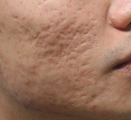 因痘痘粉刺变月球表面脸,痘坑怎么修复?