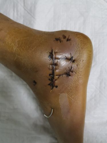 微创跗骨窦切口治疗跟骨粉碎性骨折并跟骰关节脱位