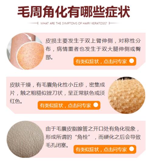 【同齐·科普】胳膊上的小疙瘩--毛周角化_治疗