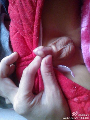 宝宝一岁四个月,今天发现他下面长了两个很大的白疙瘩