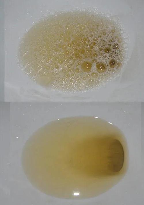 饮水量少,或者吃的是高蛋白食物,前者会使尿液中的各种物质浓度升高