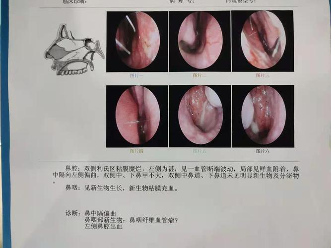 一例鼻咽部纤维血管瘤患者治疗分享
