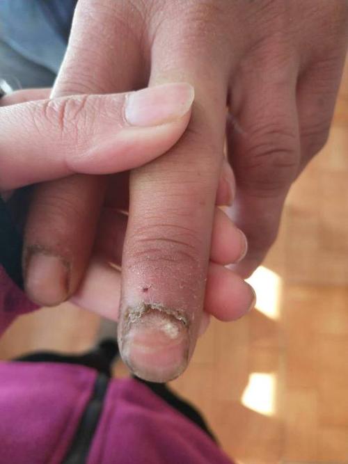 麻烦大家帮忙看看这个手指是什么病