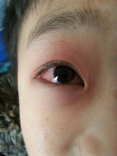 儿子昨天回家有一只眼睛红肿,眼球充血,是