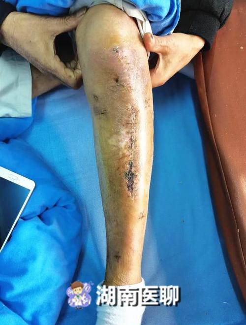 老人摔倒致骨折,生活一直靠拐杖,骨科医生靠这招化解7