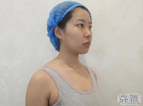 美然双平面隆胸的真实案例这是你想要的效果吗