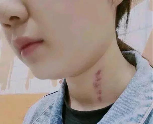 15岁女儿脖子被"种草莓",试纸检测发现怀孕,妈妈懊悔不已!