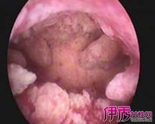 子宫内膜息肉常做以下检查:  1,妇科检查:急性炎症可见宫颈充血水肿