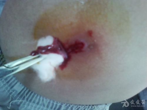 常见皮肤病疖深部脓疱疮有图有真相