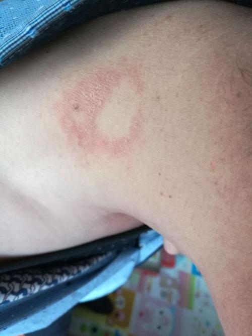 圈癣在不经意间就治好