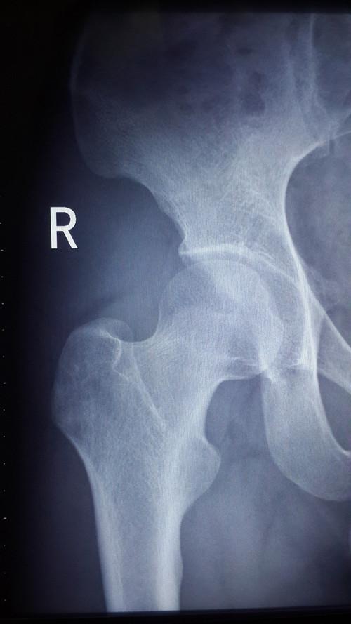 双髋关节x光照片