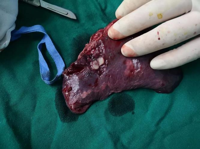 首先需要明确的是,肺部肿瘤并不等于肺癌,因为肺部肿瘤也分良性