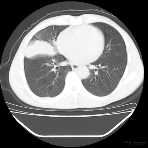 肺癌ct片 ! - 医学影像学讨论版 - 爱爱医医学论坛