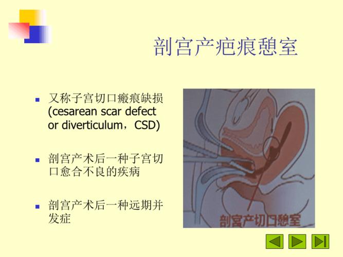 剖宫产疤痕憩室的诊断和治疗