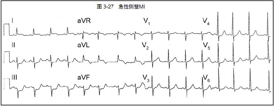 图文详解心肌缺血和梗死的心电图