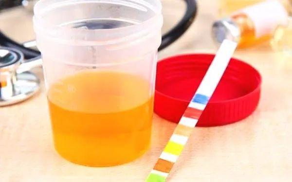 丨肾病实验室丨不可不知的"蛋白尿"二三事