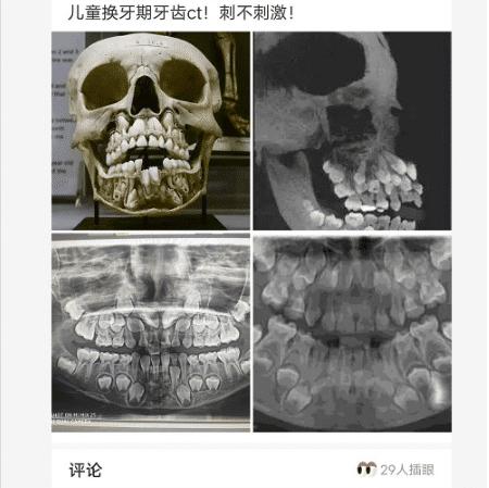 孩子换牙期间的x光片也太恐怖了!下颌骨里藏的全是牙齿,哈哈哈