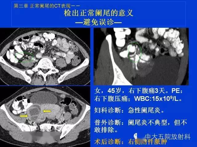全面讲解正常阑尾和阑尾炎的ct表现