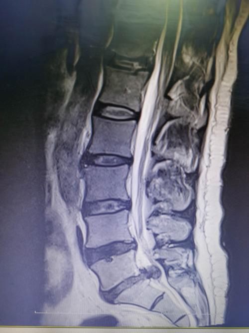 15床 腰5骶1椎间盘突出症 脱垂型