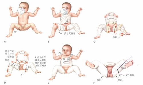 婴儿髋关节脱位自查图
