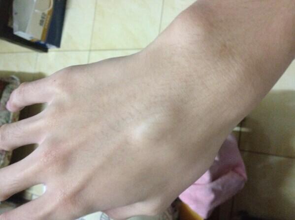 手背上长了一个像肿瘤的东西,软软的可以移动.不痛没感觉,是什么?