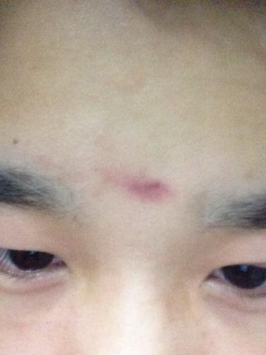 不知道什么原因,印堂发红有些偏黑是什么原因?迷信者绕道而行