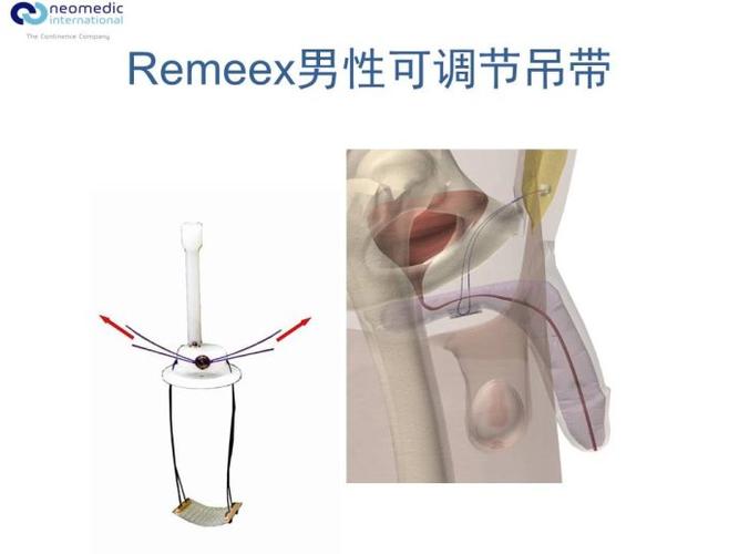 尿失禁及吊带发展进展之二