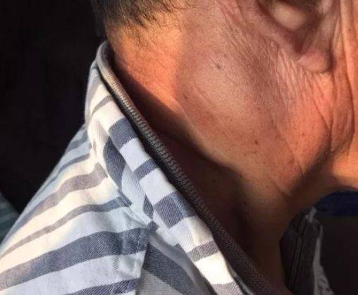 男子脖子鼓出个疙瘩,一