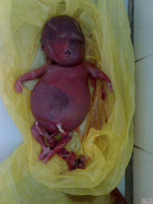 [妇科] barts胎儿水肿综合征图片