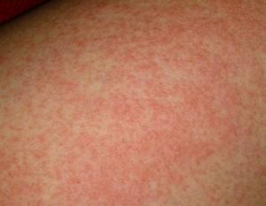 过敏性皮肤病荨麻疹发展