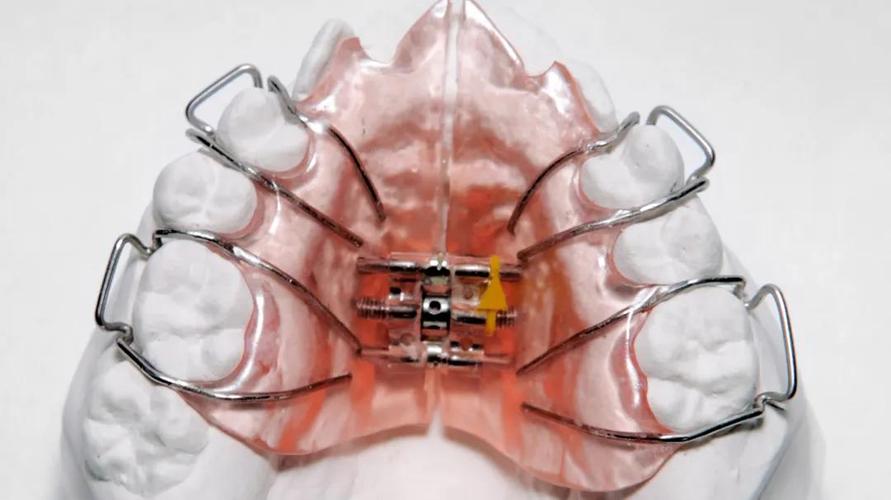 活动矫治器的一种