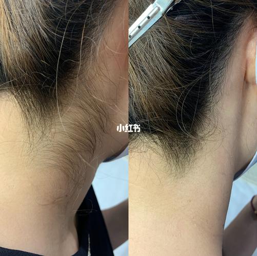 脱毛后发际线_脱毛_脱发_发际线_脱发际线_美妆_个人护理_头发产品