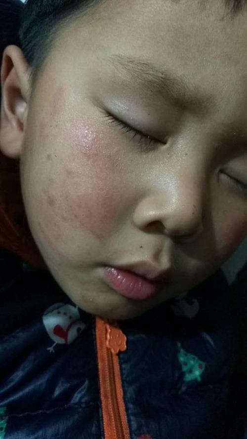 谁知道儿童脸上长癣怎么治