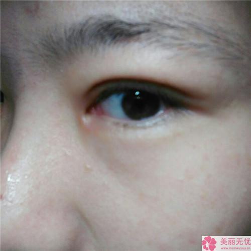 内眼角开大整形术和外眼角开大具有何种特征