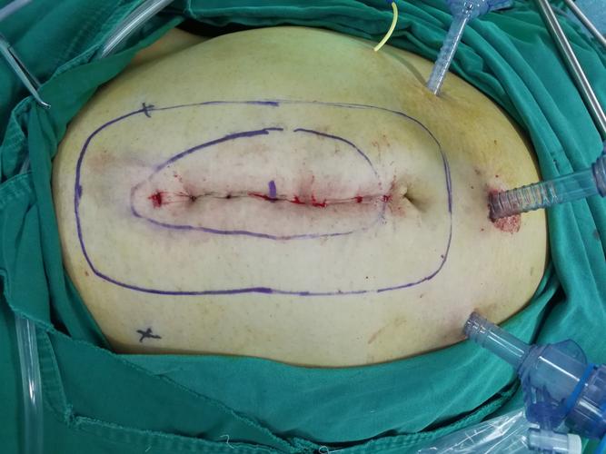 切口疝的修补过程,给你介绍一下