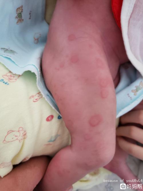 现在身上又起了这种红斑,红斑凸起一圈,中间发白.