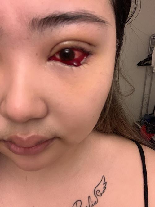 切开双眼皮提肌外眼角下至后第四天眼睛出血好多!好恐怖!这是怎么回事