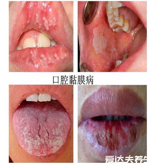 感染后的白色念珠菌图片,呈豆渣样分泌物不及时治疗会