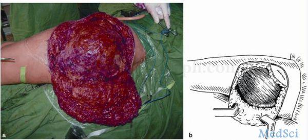 臀部巨大软组织肉瘤 怎么切除是个问题