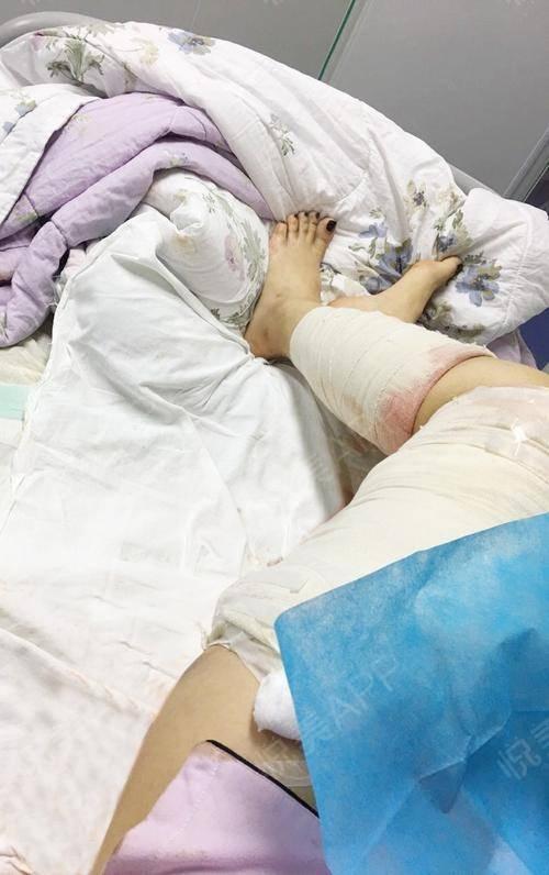 终于取下了绷带和厚棉布,我偷偷捏了下大腿,有些浮肿下但能摸到大腿的
